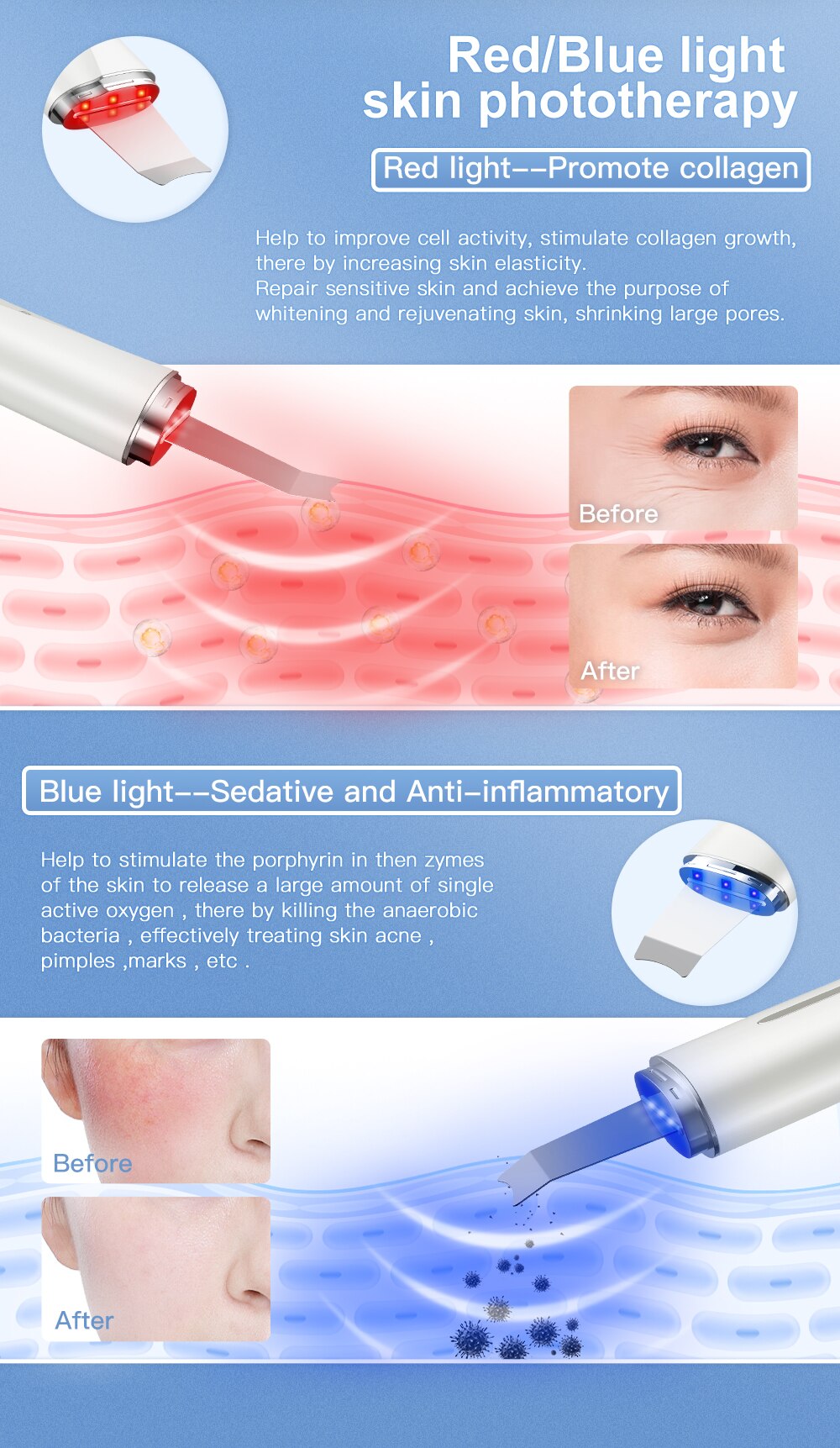 ANLAN Ultrasonic Skin Scrubber Blue Light Skin Care Deep Face Cleaning Peeling Shovel Facial Pore Cleaner Facial Lifting Machine