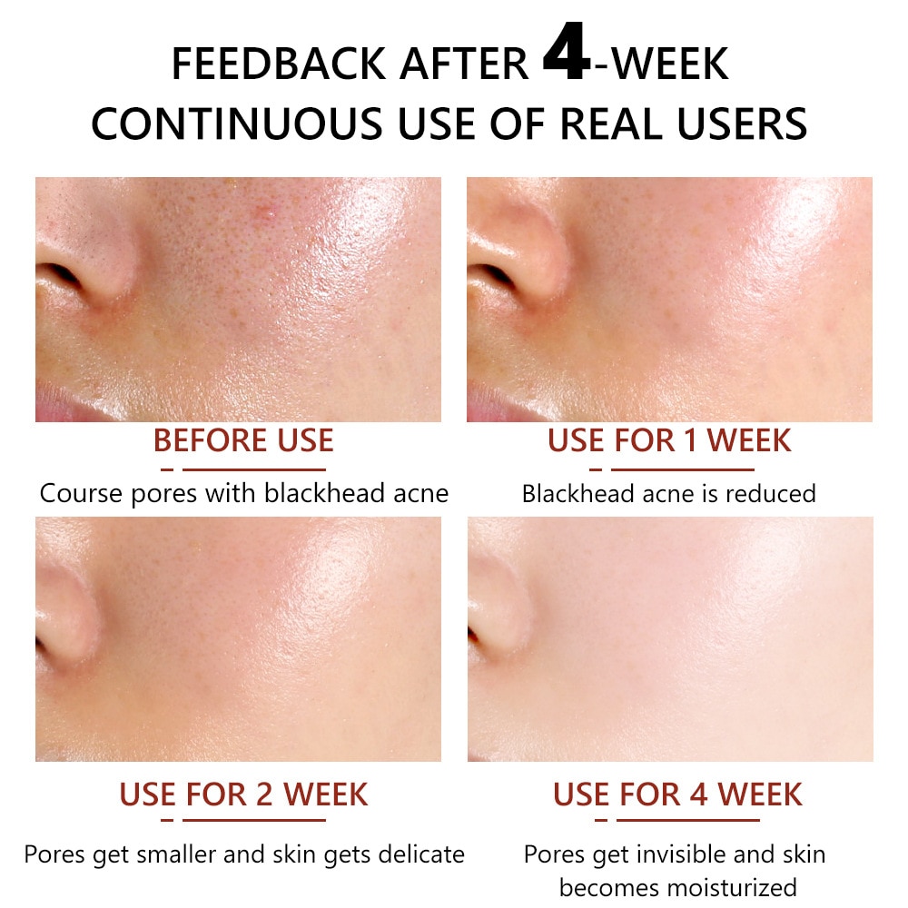 Salicylic Acid Facial Serum Improve Oily Skin Clean Pores Remove Blackhead Face Essence Relieves Redness Acne Treatment Solution Salicylic Acid Facial Serum Improve Oily Skin Clean Pores Remove Blackhead Face Essence Relieves Redness Acne Treatment Solution