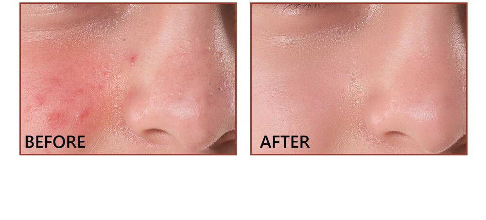 Salicylic Acid Facial Serum Improve Oily Skin Clean Pores Remove Blackhead Face Essence Relieves Redness Acne Treatment Solution