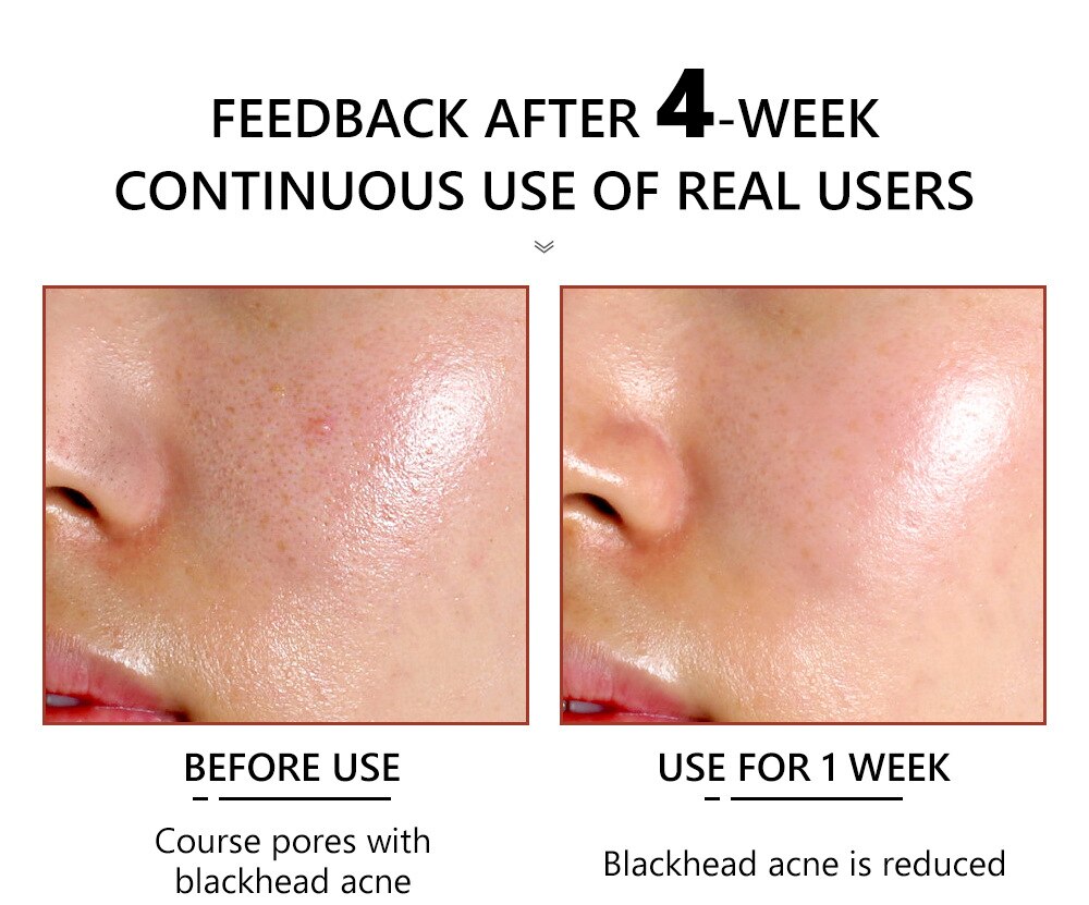 Salicylic Acid Facial Serum Improve Oily Skin Clean Pores Remove Blackhead Face Essence Relieves Redness Acne Treatment Solution