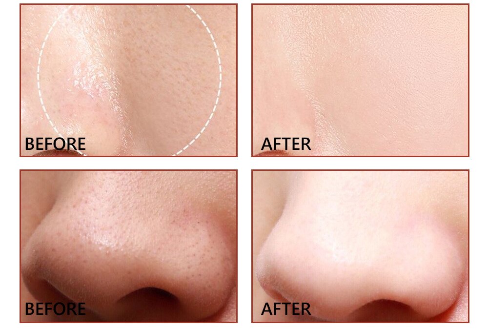 Salicylic Acid Facial Serum Improve Oily Skin Clean Pores Remove Blackhead Face Essence Relieves Redness Acne Treatment Solution