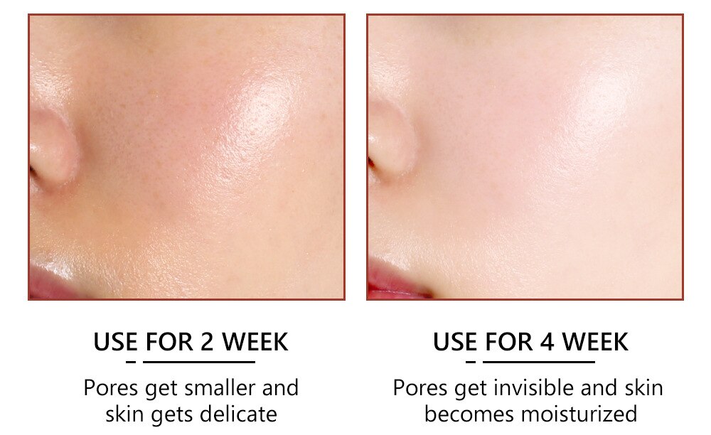 Salicylic Acid Facial Serum Improve Oily Skin Clean Pores Remove Blackhead Face Essence Relieves Redness Acne Treatment Solution