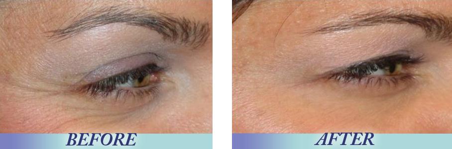 Pure Retinol Vitamin A 2.5% + Hyaluronic Acid Skin Care Acne Cream Removal Spots Facial Anti Wrinkle Whitening Face Serum