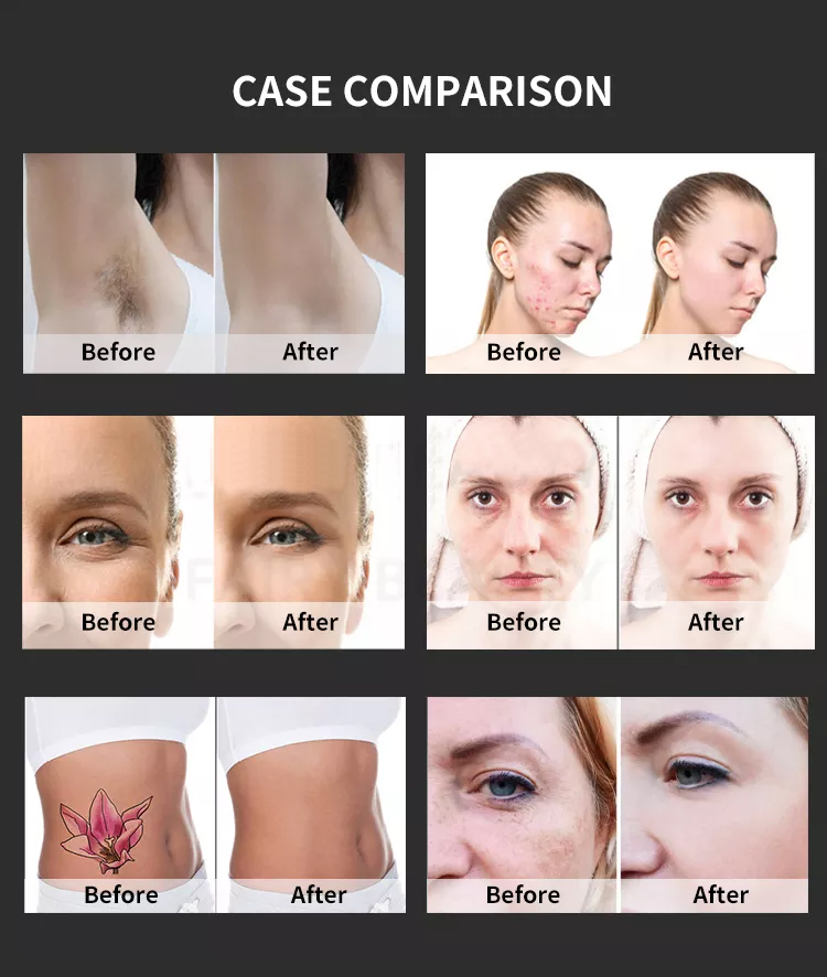 Multifunctional 2 in 1 laser hair removal portable tattoo removal IPL opt hair removal machine diode laser machine