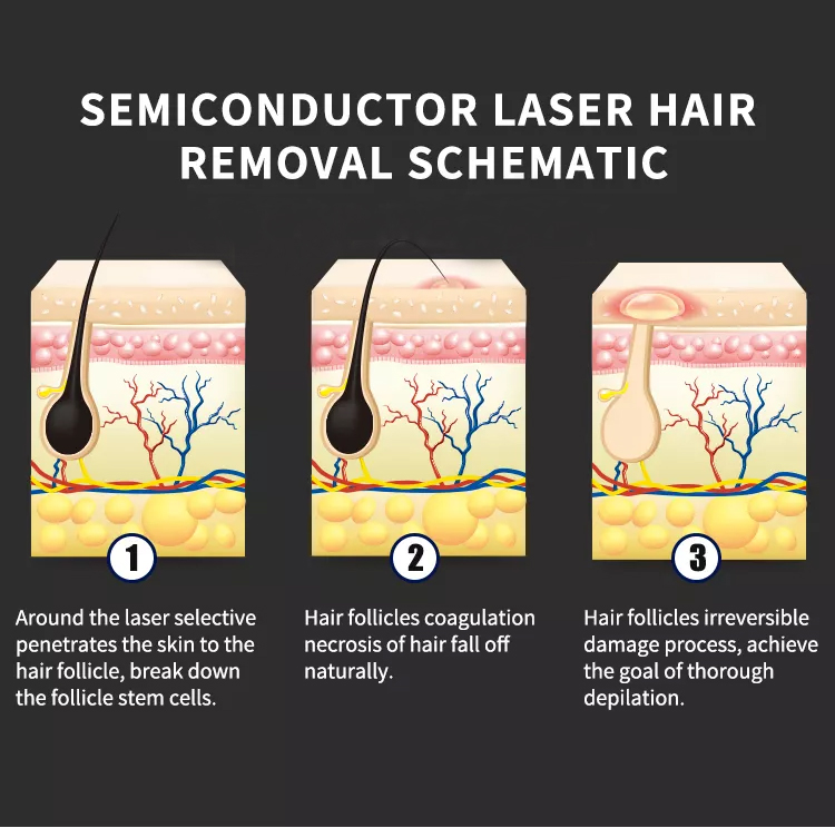 Multifunctional 2 in 1 laser hair removal portable tattoo removal IPL opt hair removal machine diode laser machine