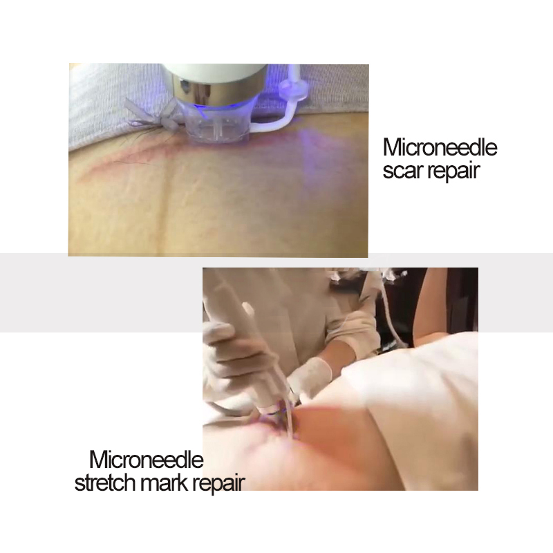 Fractional Rf Microneedle Radio Frequency Microneedling Machine Facial Thermage Skin Tightening Lifting Care Device For Face