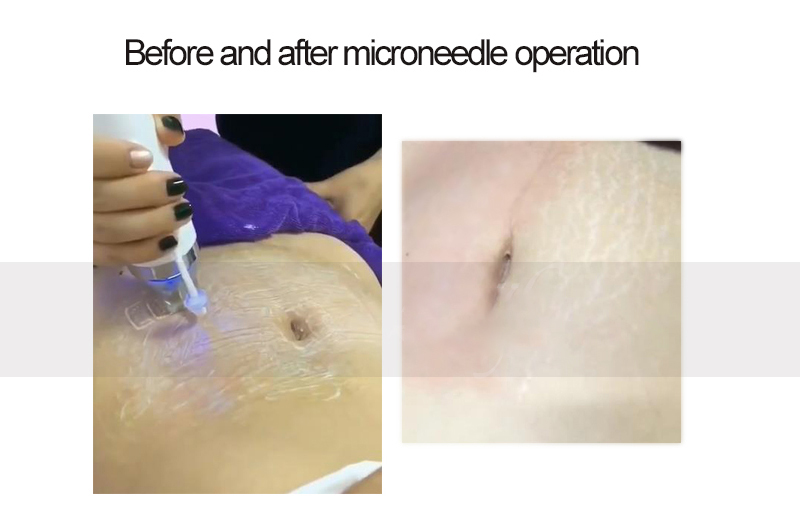 Fractional Rf Microneedle Radio Frequency Microneedling Machine Facial Thermage Skin Tightening Lifting Care Device For Face