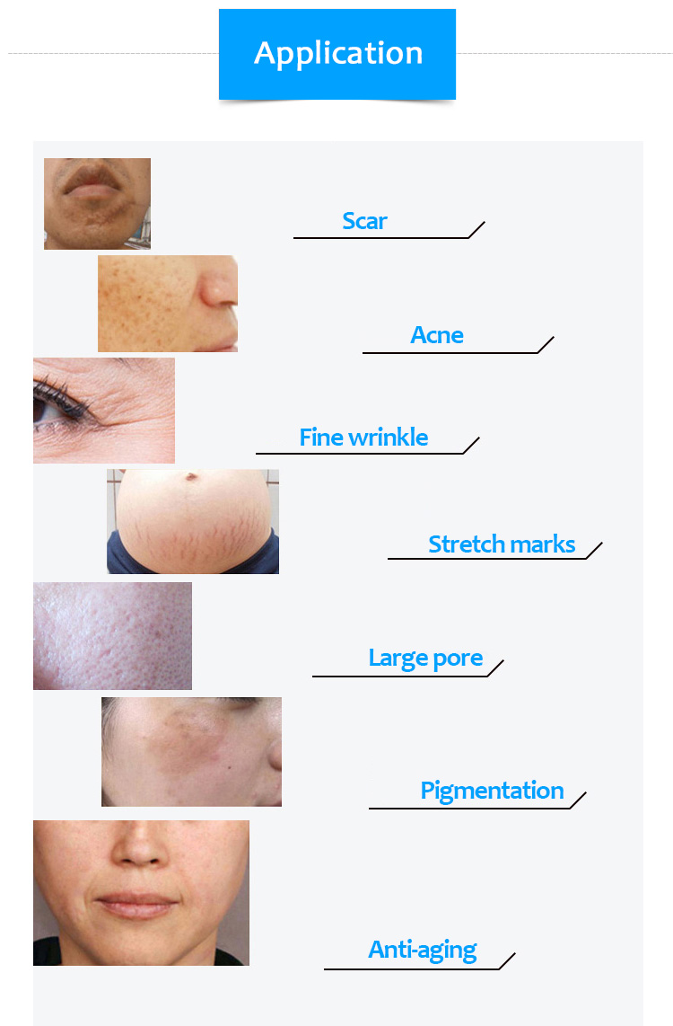 3 In 1 Rf Microneedling Machine Nano Radiofrequency Fractional Skin Tightening Microneedle 2 In 1 Gold Professional Machine Ems 3 In 1 Rf Microneedling Machine Nano Radiofrequency Fractional Skin Tightening Microneedle 2 In 1 Gold Professional Machine Ems
