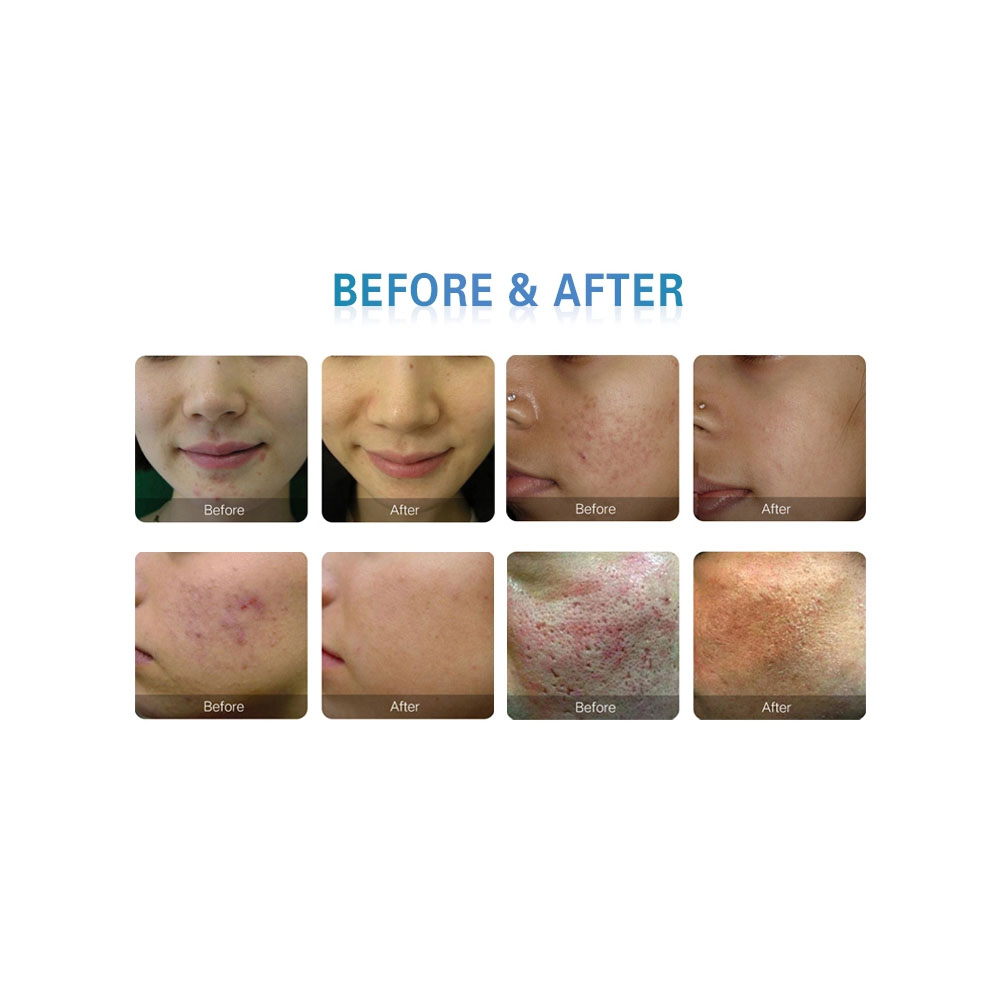 2023Multifunctional RF Microneedle Machine morpheus 8 skin tightening machine original Acne/Stretch Marks/Scars Wrinkle Removal