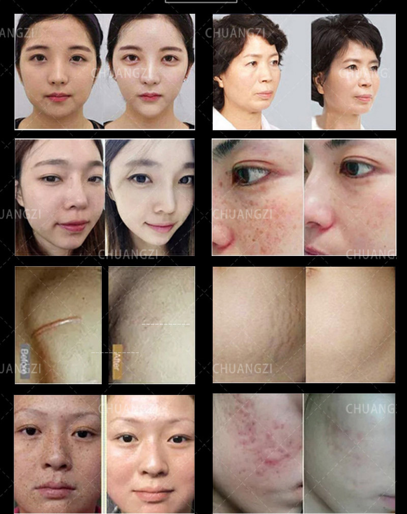 2023Multifunctional RF Microneedle Machine morpheus 8 skin tightening machine original Acne/Stretch Marks/Scars Wrinkle Removal