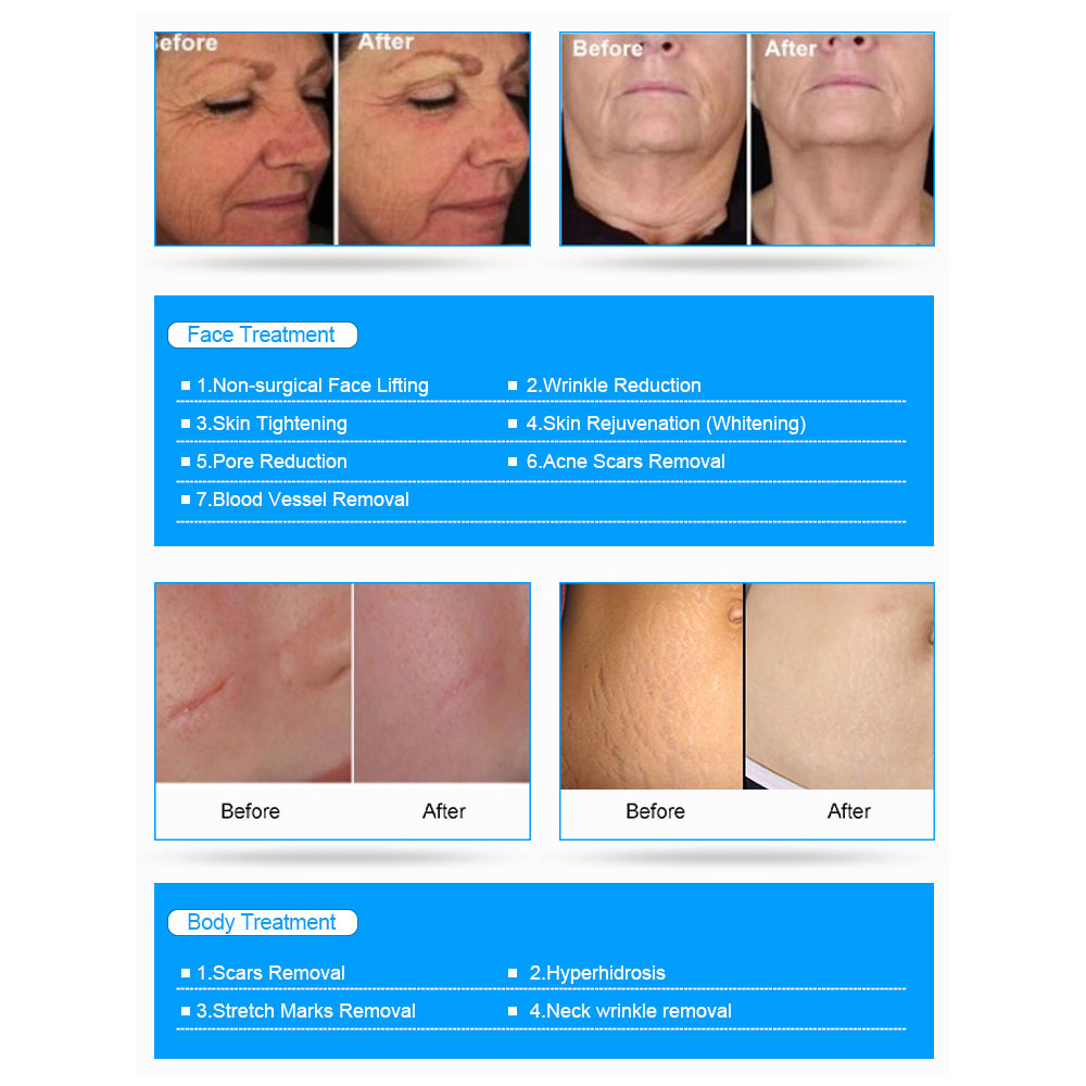 2023Multifunctional RF Microneedle Machine morpheus 8 skin tightening machine original Acne/Stretch Marks/Scars Wrinkle Removal