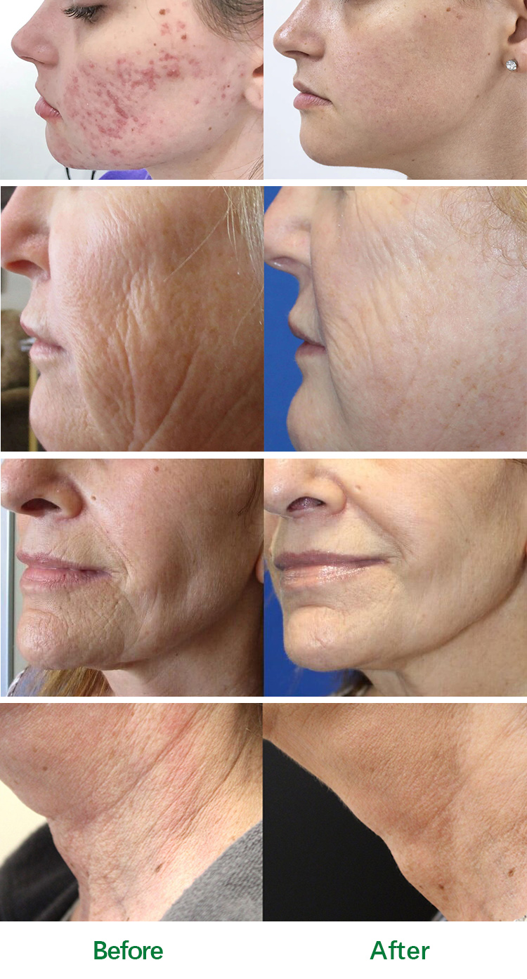 2 in 1 fractional  microneedling machine with cryo cold hammer stretch marks scar remover rf fractional micro needle machine