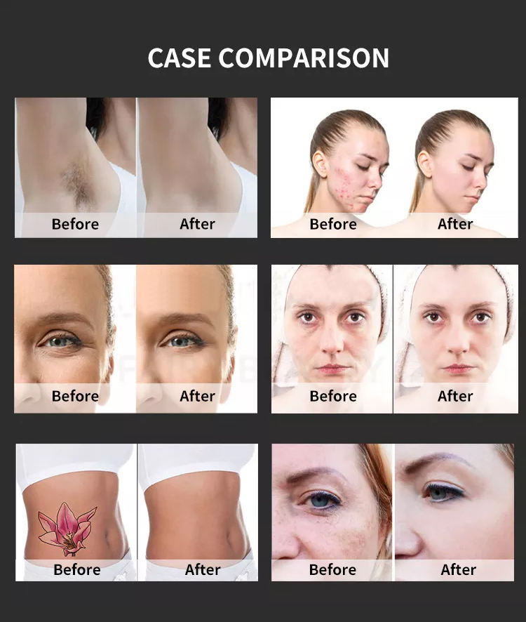 2023 Latest 2 In1Personal Care Appliances E-light+IPL OPT ND YAG Laser Multifunction Beauty Tattoo Hair Removal Machine