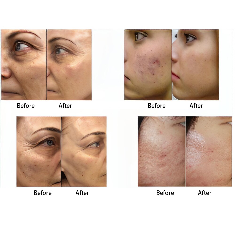 Latest Fractional Micro RF Micro Beauty Cold Hammer RF Machine Face Lift Anti-Acne Skin Morpheus 8