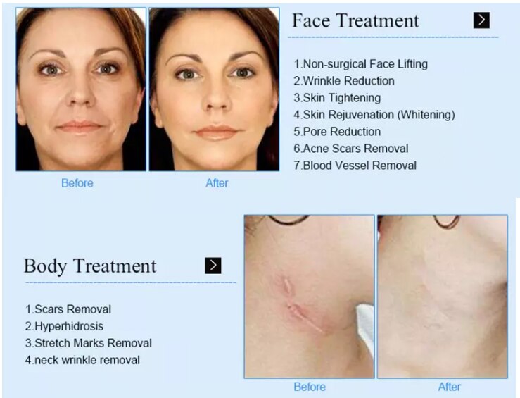 Latest Fractional Micro RF Micro Beauty Cold Hammer RF Machine Face Lift Anti-Acne Skin Morpheus 8
