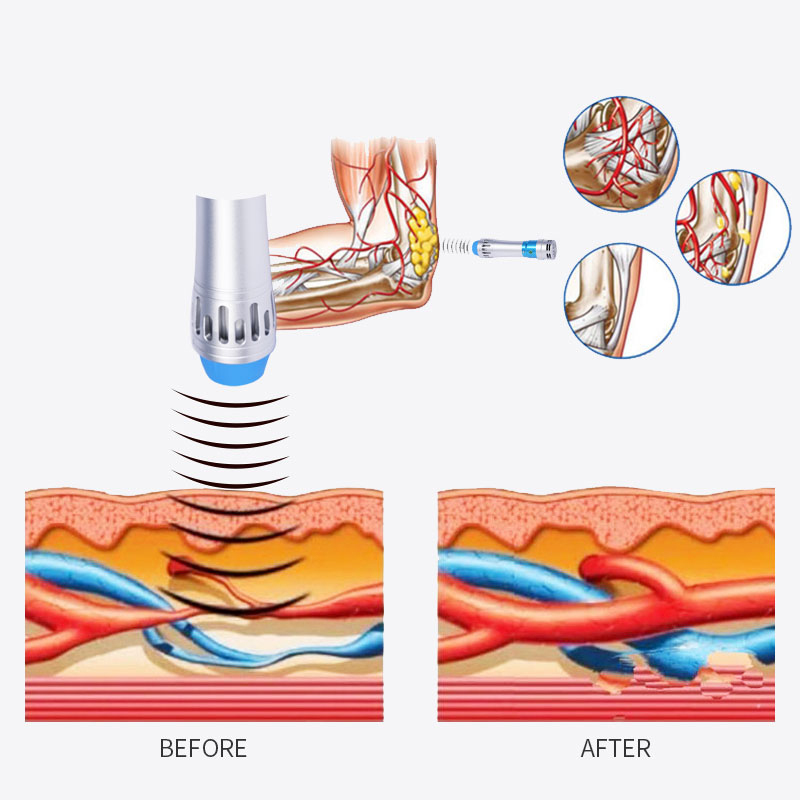 Portable Physical Therapy Equipment ED Electromagnetic Extracorporeal Shock Wave Therapy Machine Pain Relief Body Relax Massager